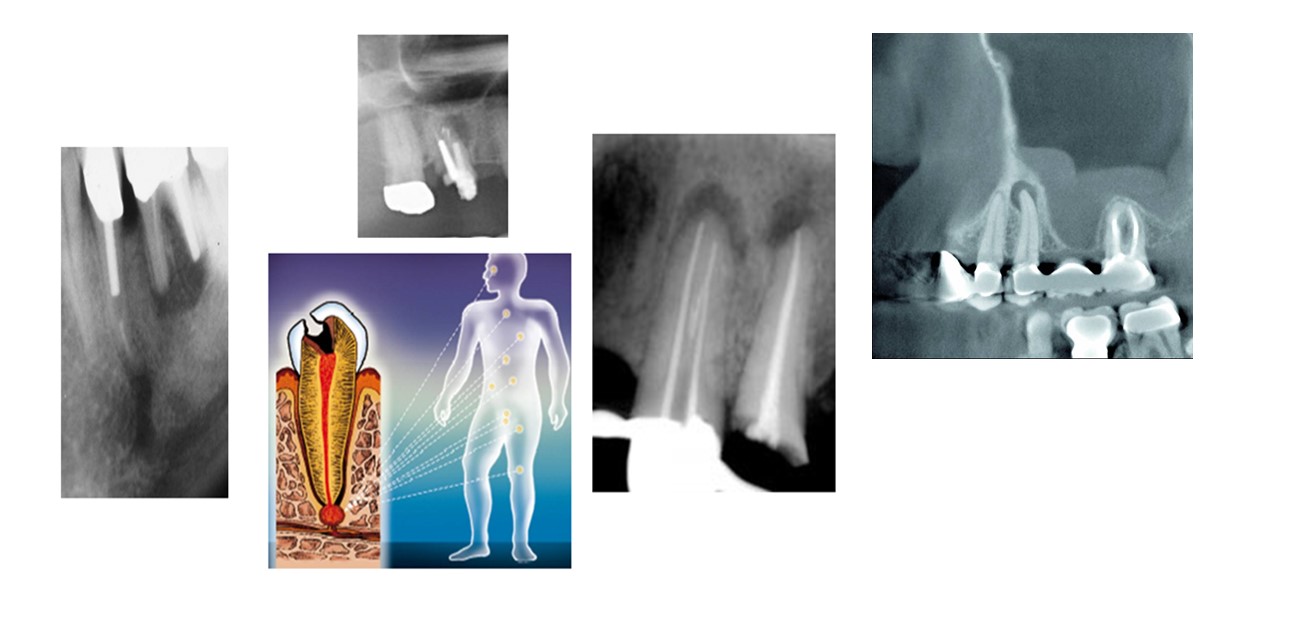 Apikale pathologische Veränderungen an Zahnwurzeln