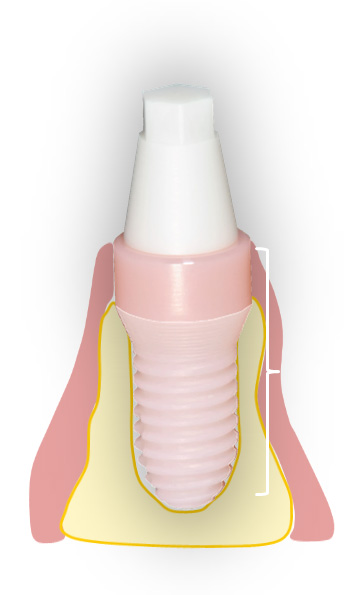 implantat_g_line-1 implantat_g_line-1