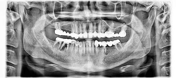 Panoramic X-ray image of upper and lower jaw teeth by tomography. 2D